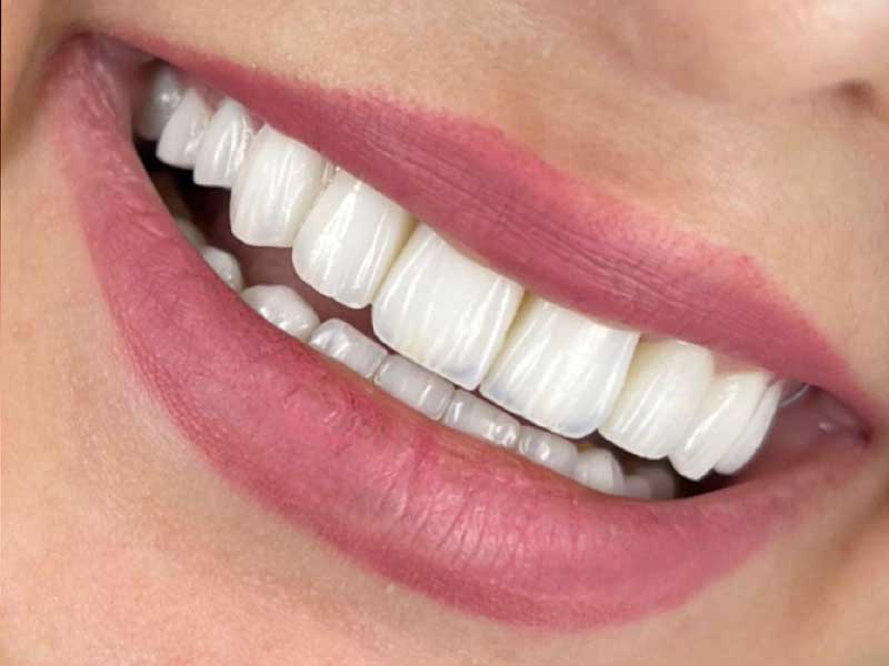 Veneers