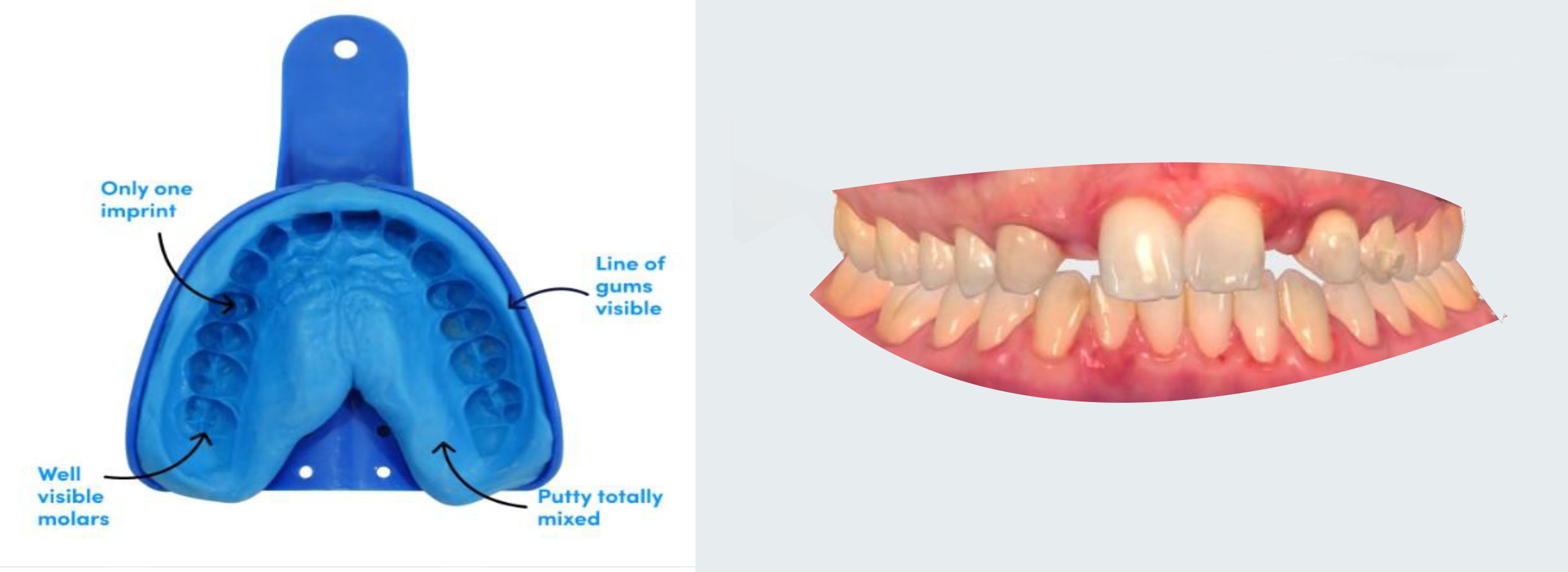 zirconia crown and briges