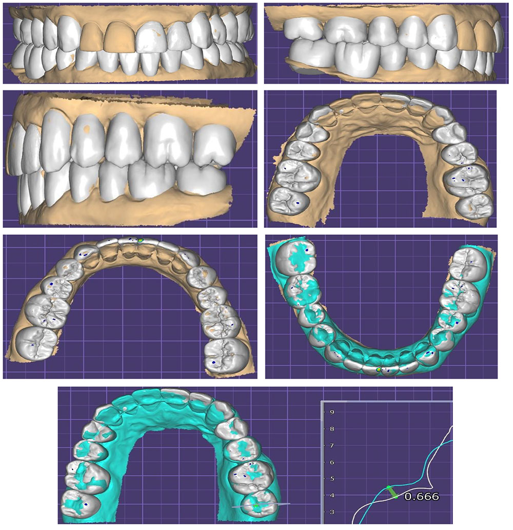 dental prosthetics