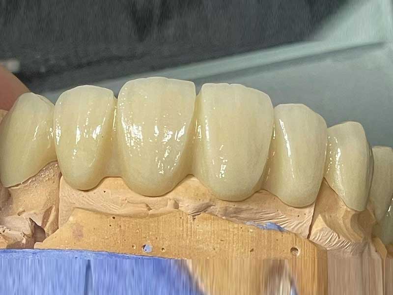 zirconia crown and briges